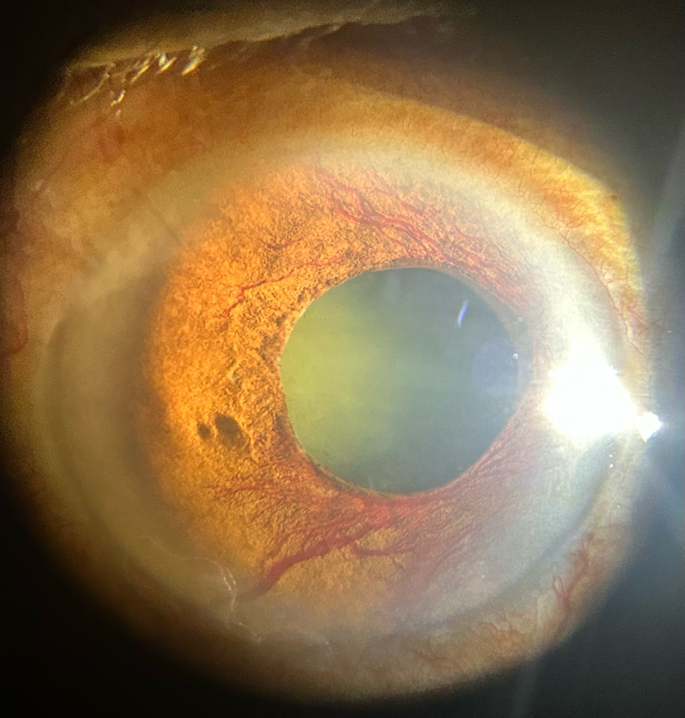 Photo Talk Winners – Glaucoma Society of India
